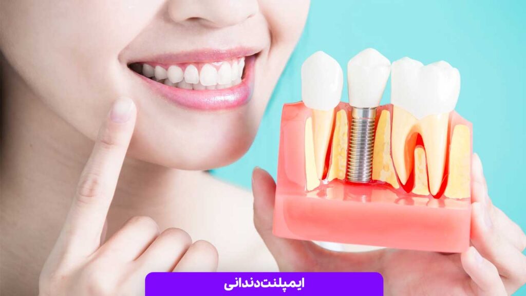 ایمپلنت دندانی