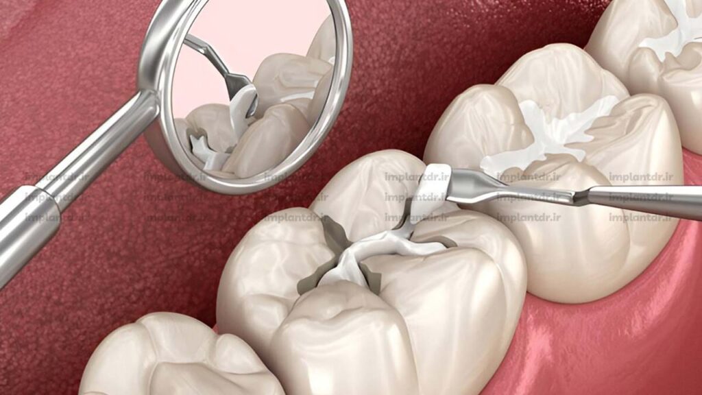 پر کردن دندان چیست؟