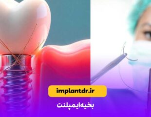 بخیه ایمپلنت