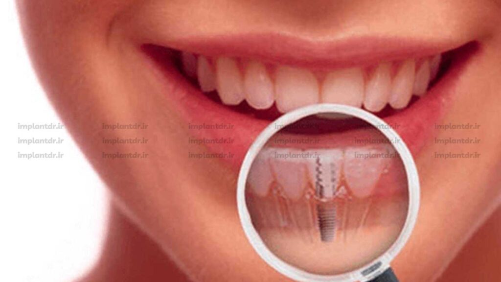 حساسیت به ایمپلنت دندان با آسیب به لایه اکسید تیتانیوم