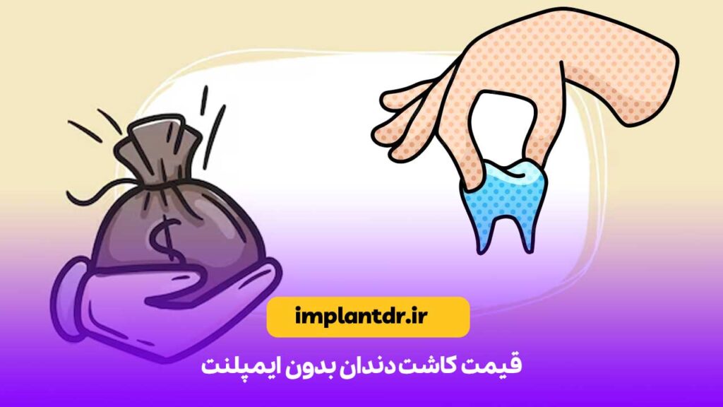 قیمت کاشت دندان بدون ایمپلنت