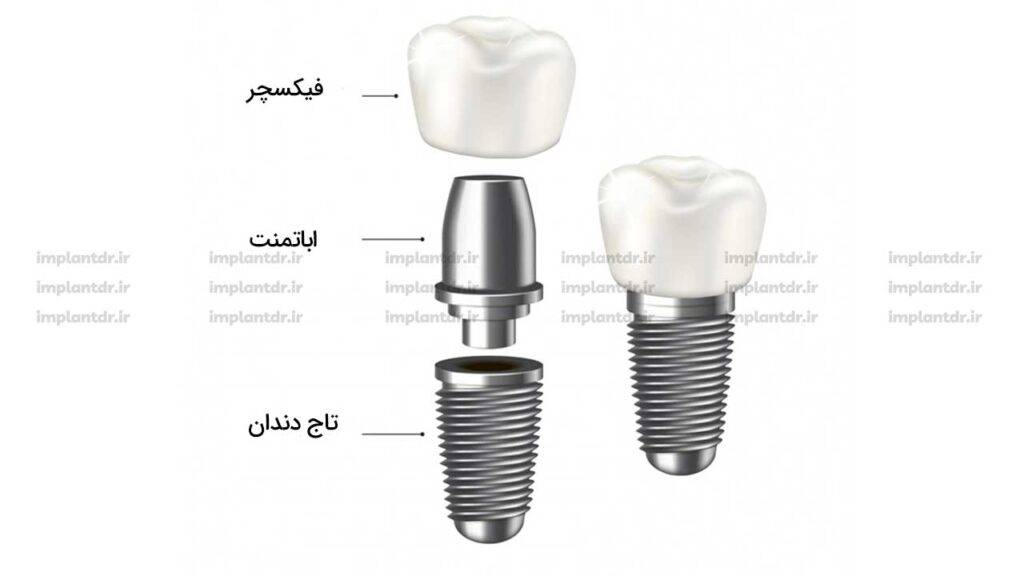 اجزای ایمپلنت دندان