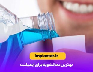 بهترین دهانشویه برای ایمپلنت