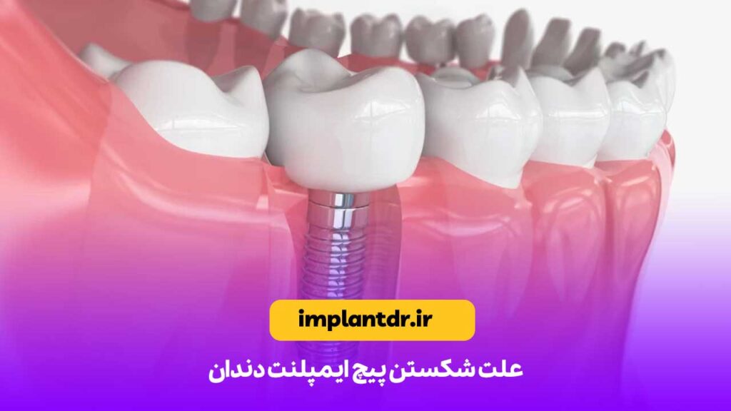 علت شکستن پیچ ایمپلنت دندان