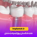 علت شکستن پیچ ایمپلنت دندان