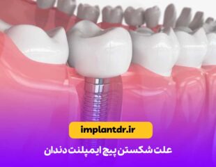 علت شکستن پیچ ایمپلنت دندان