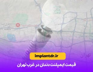 قیمت ایمپلنت دندان در غرب تهران
