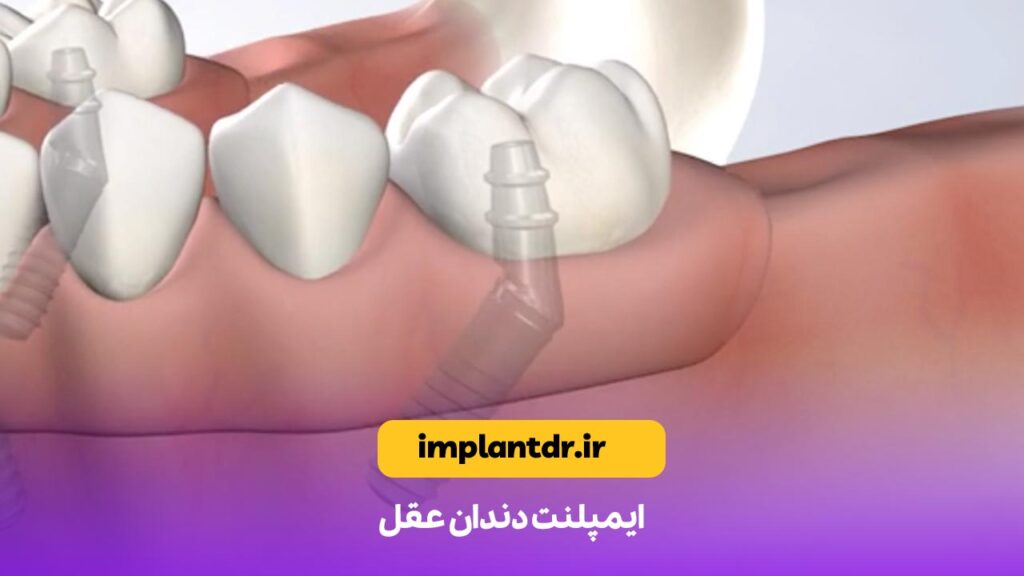 ایمپلنت دندان عقل