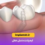 ایمپلنت دندان عقل