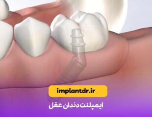 ایمپلنت دندان عقل