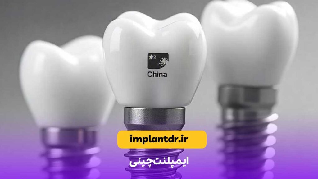 ایمپلنت چینی