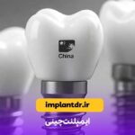 ایمپلنت چینی