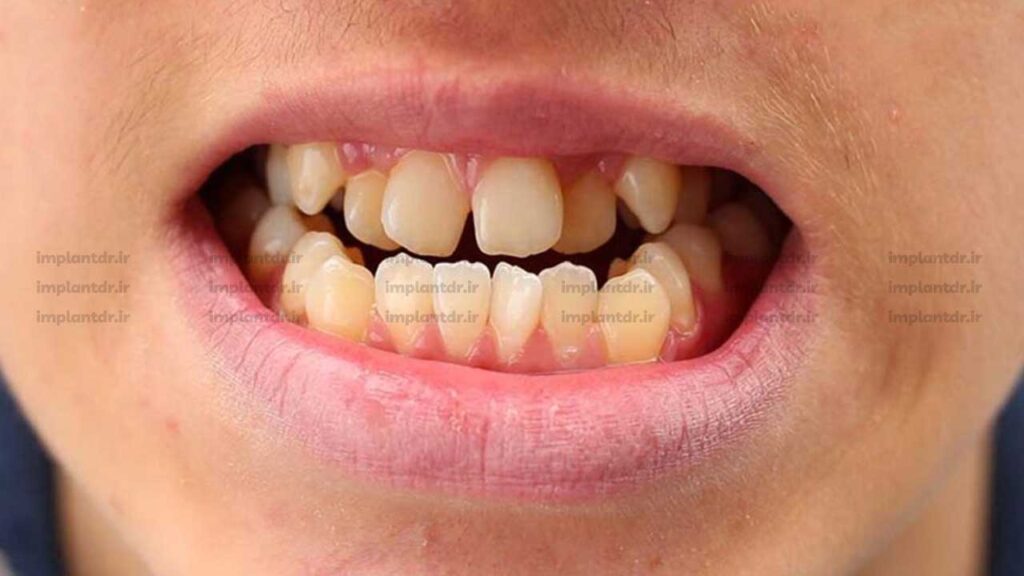 مال اکلوژن یا بایت از دیگر مشکلات روکش دندان