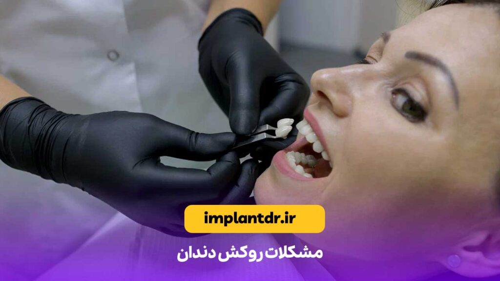 مشکلات روکش دندان