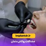 مشکلات روکش دندان
