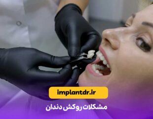 مشکلات روکش دندان