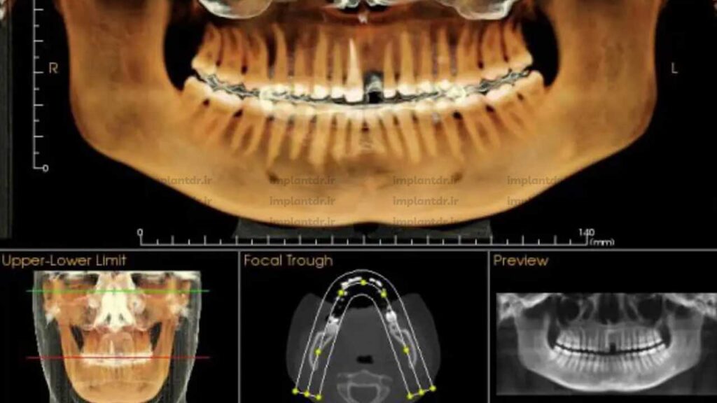 عکس دندان CBCT