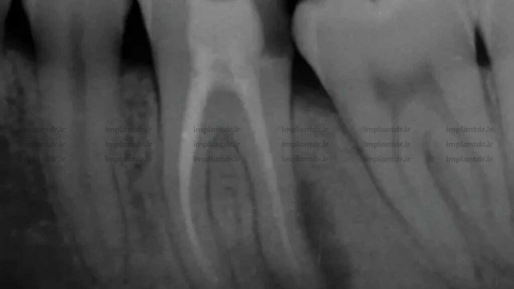 رادیوگرافی پری اپیکال (Periapical)