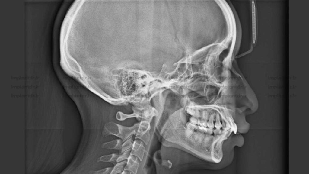 عکسبرداری لترال سفالومتری (Cephalometric)