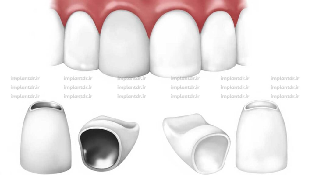 قیمت روکش دندان در سال 1404