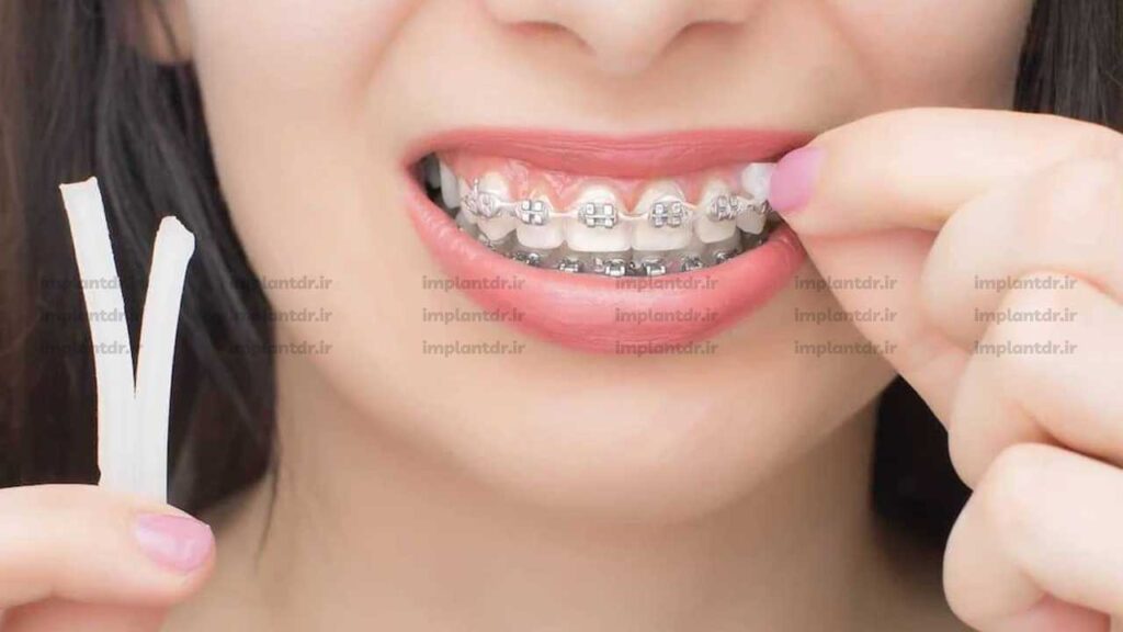اعمال موم ارتودنسی به براکت شل شده یا سیم شکسته