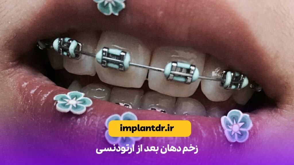 زخم دهان بعد از ارتودنسی
