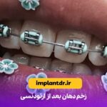 زخم دهان بعد از ارتودنسی