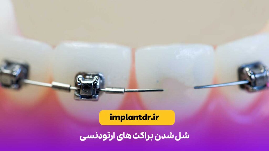 شل شدن براکت های ارتودنسی