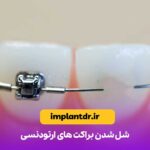 شل شدن براکت های ارتودنسی