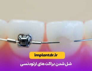 شل شدن براکت های ارتودنسی