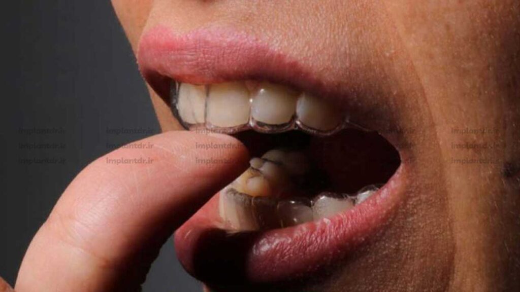 نحوه استفاده از ارتودنسی نامرئی الاینرهای شفاف
