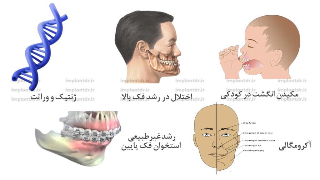 دلایل بزرگی فک پایین 