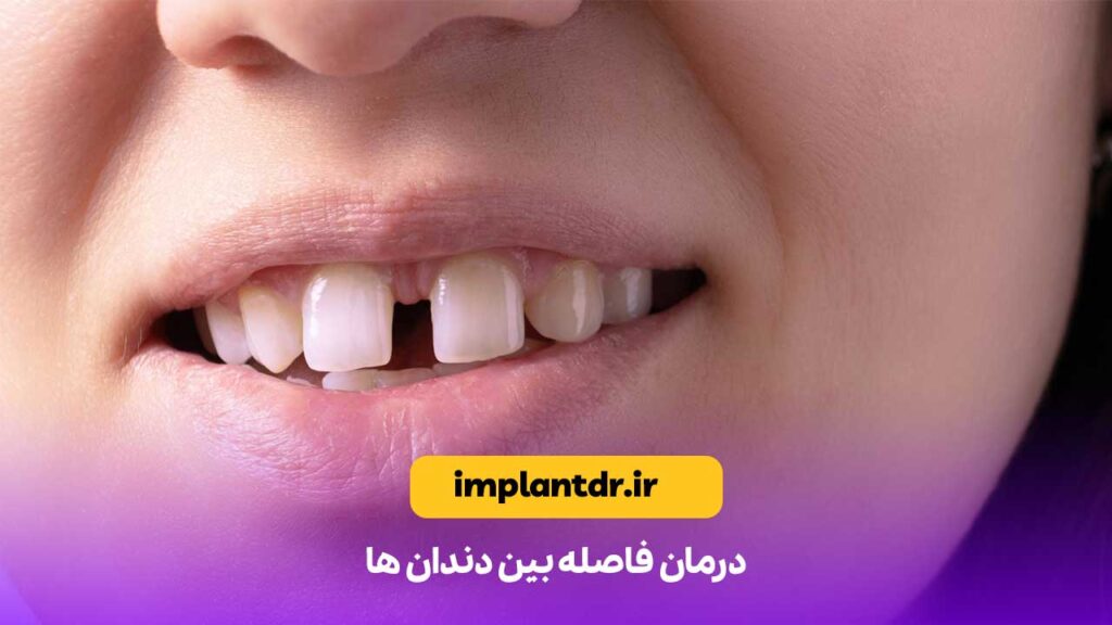 درمان فاصله بین دندان ها