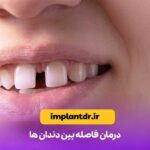 درمان فاصله بین دندان ها