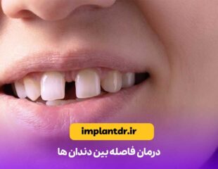 درمان فاصله بین دندان ها
