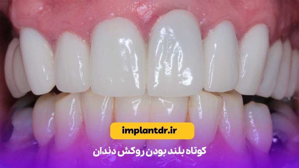 کوتاه بلند بودن روکش دندان
