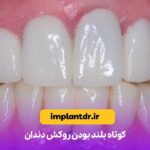 کوتاه بلند بودن روکش دندان