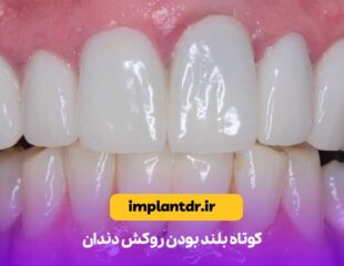 کوتاه بلند بودن روکش دندان