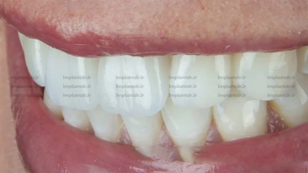 اثرات کوتاه بلند بودن روکش دندان