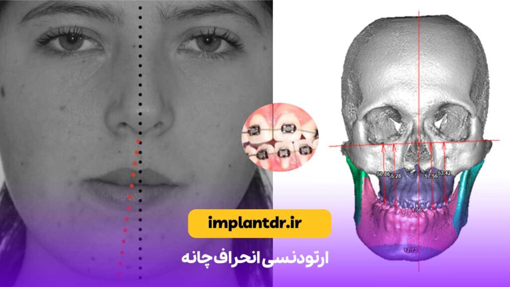 ارتودنسی انحراف چانه