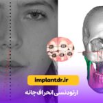 ارتودنسی انحراف چانه