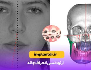 ارتودنسی انحراف چانه