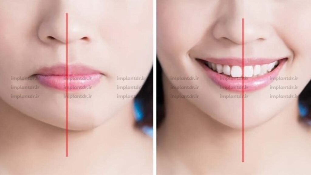 انحراف چانه چیست؟