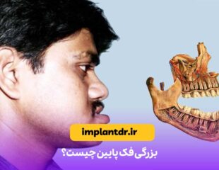 بزرگی فک پایین چیست؟
