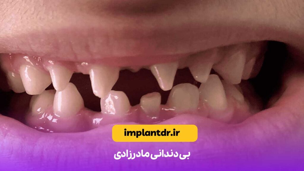 بی دندانی مادرزادی