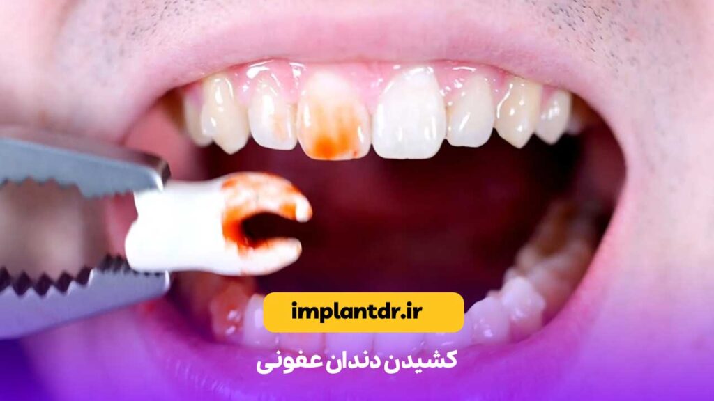 کشیدن دندان عفونی
