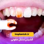 کشیدن دندان عفونی