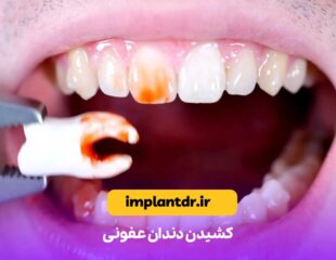 کشیدن دندان عفونی
