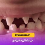بی دندانی مادرزادی