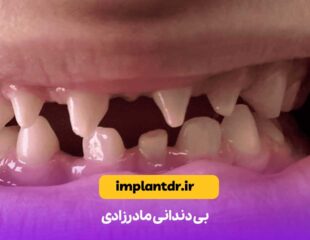 بی دندانی مادرزادی